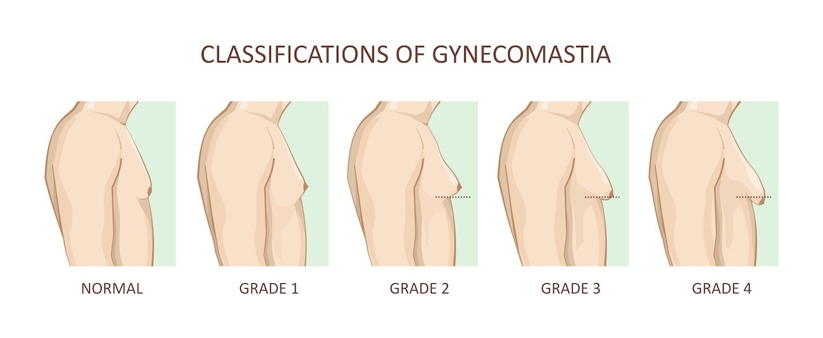 Types and classifications of gynecomastia- LA, CA