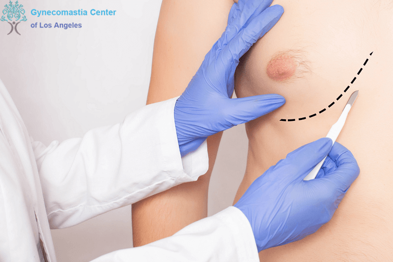 gynecomastia recovery process after surgery in Los Angeles - Gynecomastia Surgery Recovery Tips