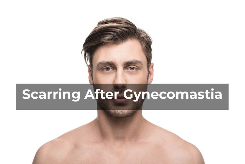 Scarring after gynecomastia surgery - Gynecomastia Center of Los Angeles