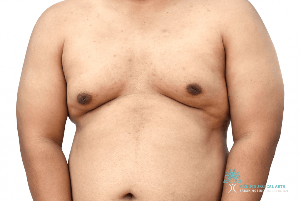 a man suffering from male breast growth in & near Los Angeles - Gynecomastia Surgery Do’s and Don’ts