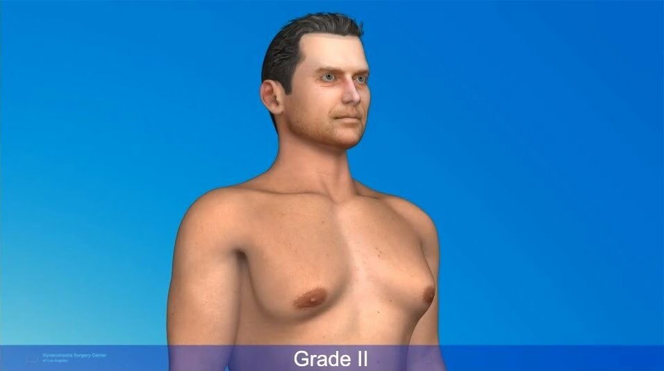 Grade 2 Gynecomastia LA, CA