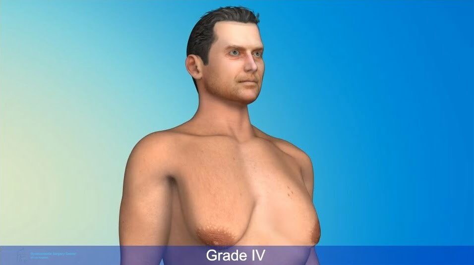 Grade gynecomastia- LA, CA