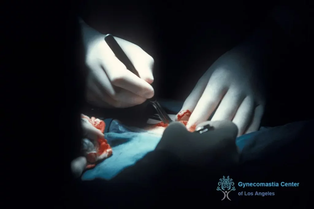 A gynecomastia surgeon performing surgery in Los Angeles - Scar Massaging After Gynecomastia Surgery