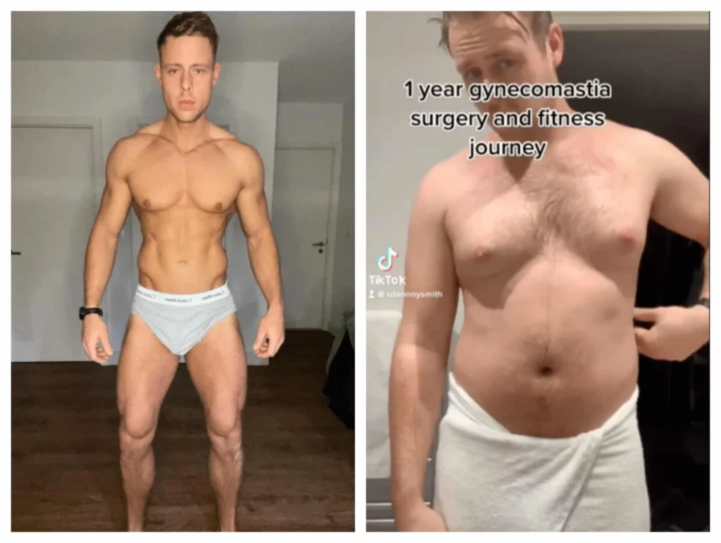 Working Out After Gynecomastia Surgery