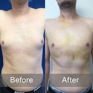 Before & After of Gynecomastia Surgery - Best Gyno Surgeon