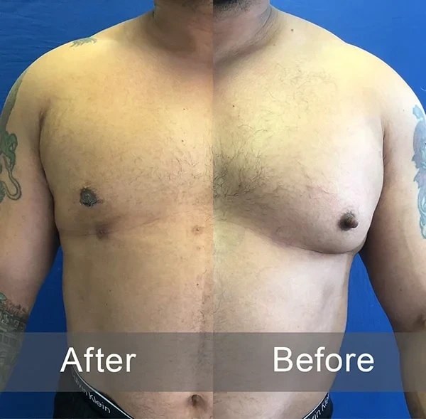 Tummy tuck before and after with gynecomastia.