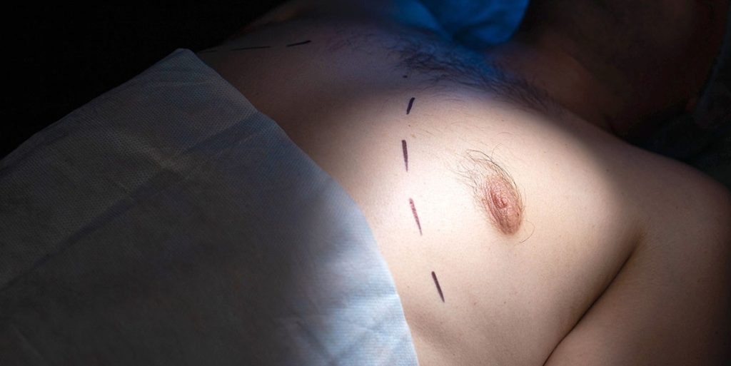High Definition Liposuction in Gynecomastia