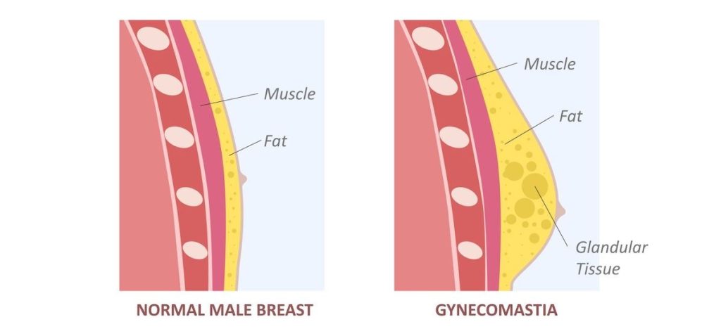 will gyno go away - Gynecomastia LA