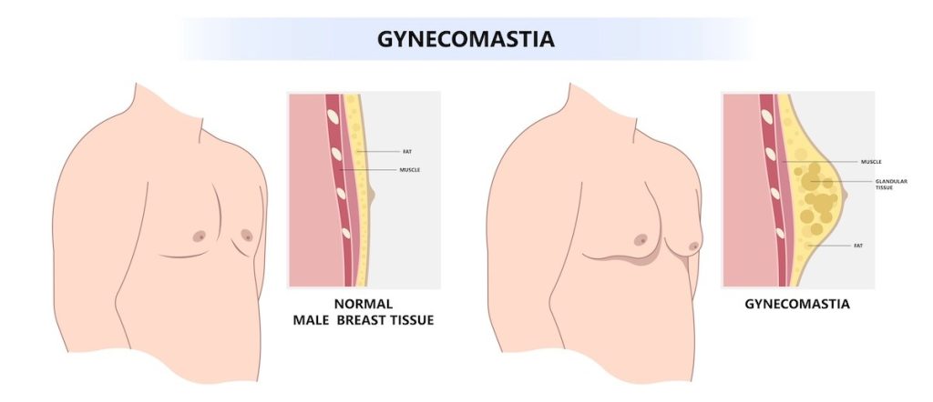 small puffy nipples - Gynecomastia LA