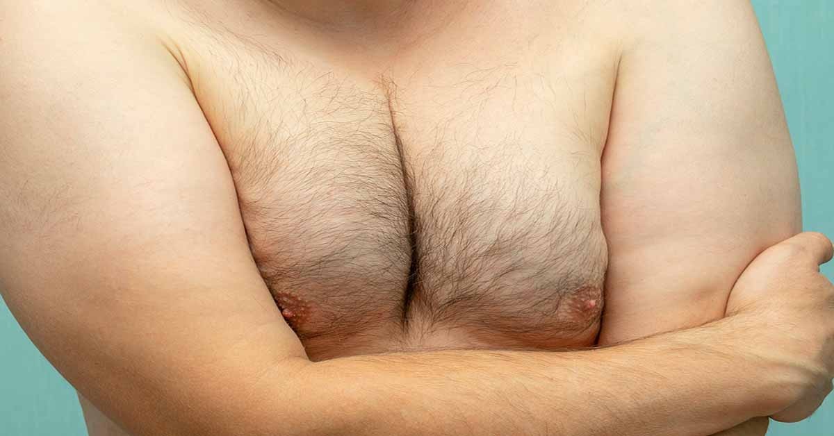 man with puffy nipples - Gynecomastia Center of Los Angeles