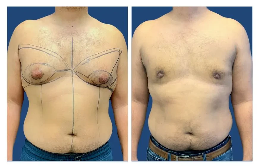 Before & After of Gynecomastia Surgery