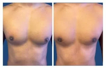 GYNO Before and After
