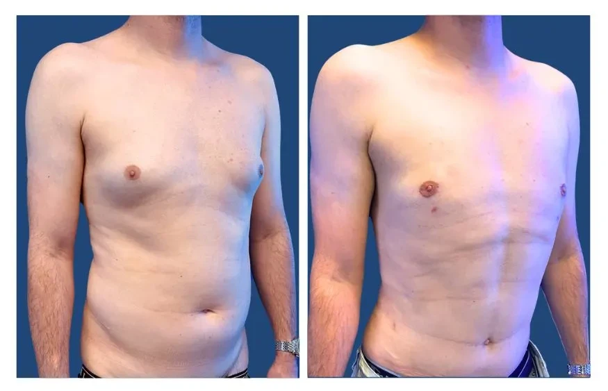 Gynecomastia Before & After LA