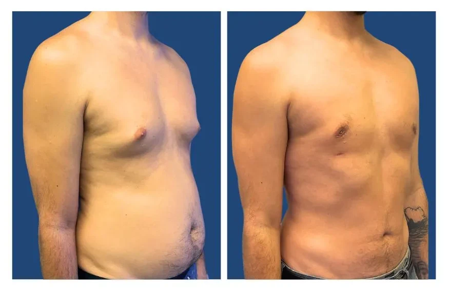 Gynecomastia LA