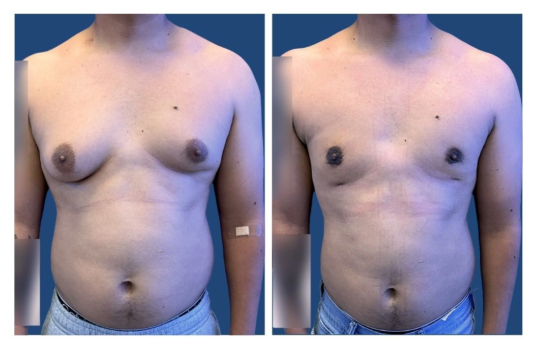 Gynecomastia Los Angeles