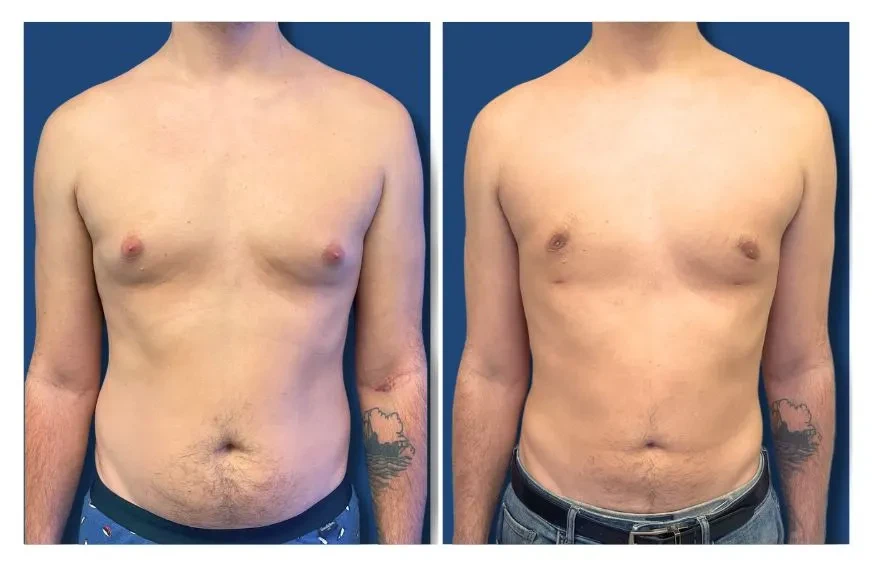 Gynecomastia Los Angeles
