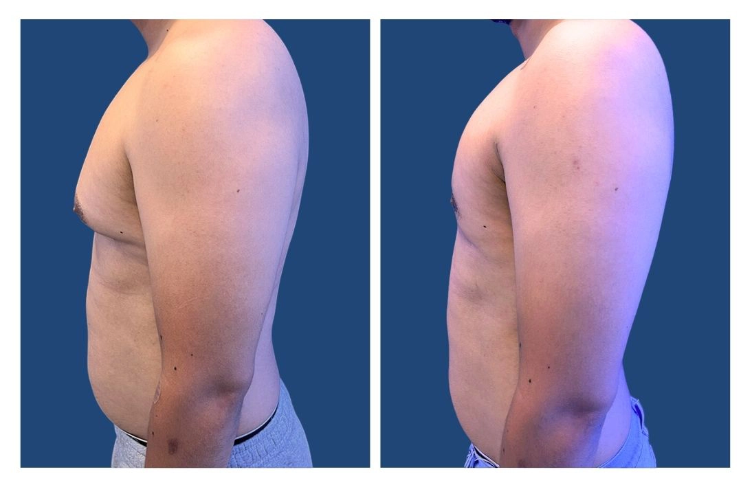 Gynecomastia Surgery Los Angeles