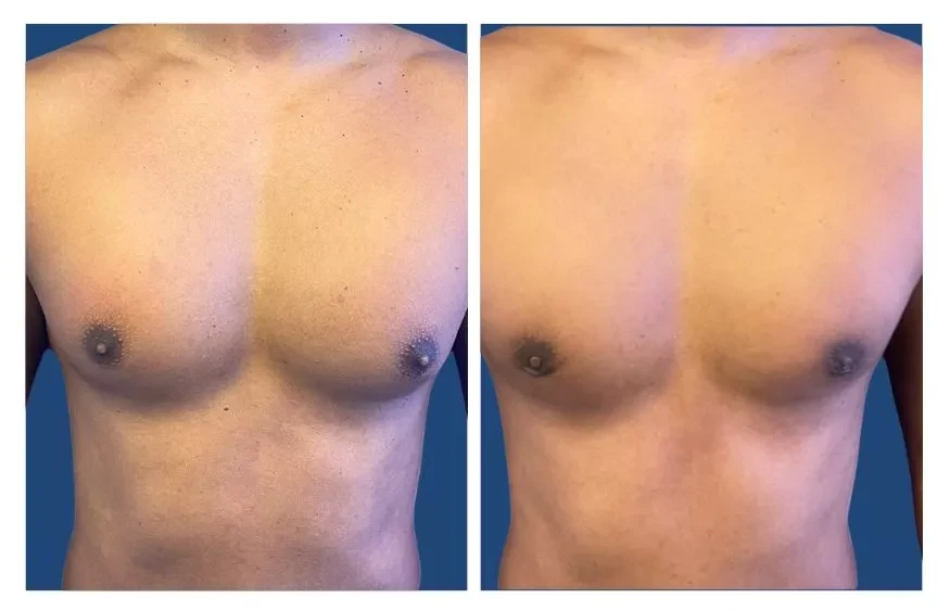 How To Get Rid Of Puffy Nipples Or Type 1 Gynecomastia?