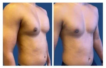 Before and after tummy tuck.
