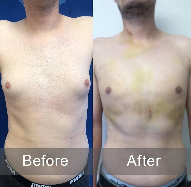before and after photo of patient who chose surgeon in & near Los Angeles - Choose a Gynecomastia Surgeon