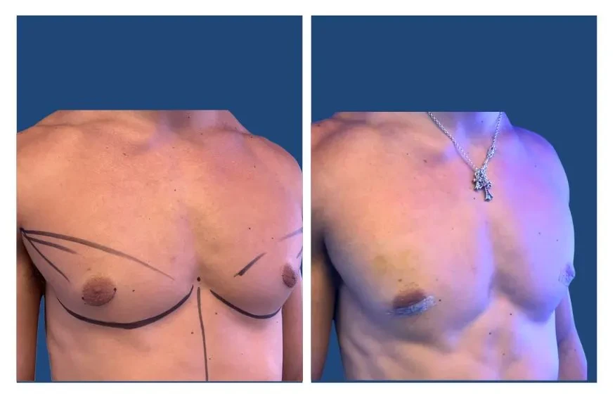 gyno before and after surgery