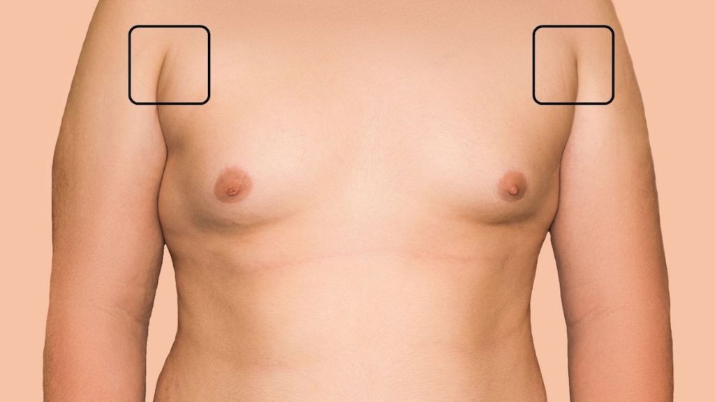 Axillary Breast Tissue - Gynecomastia Center of Los Angeles