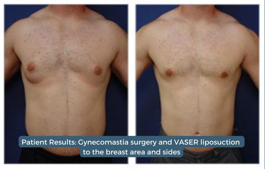 Before and After Personal Stories of Gynecomastia Surgery