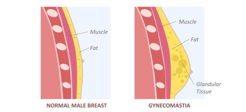 Gyno Surgery Cost in Los Angeles