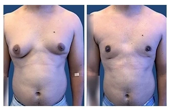 Tummy tuck for gynecomastia before and after.