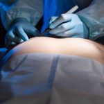 How To Prepare For Gynecomastia Surgery
