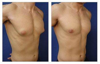 Tummy tuck before and after with gynecomastia.