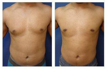 Tummy tuck and gynecomastia before and after.