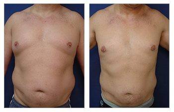 Correcting Male Breast Asymmetry Beverly Hills