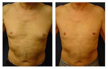 Before and after gynecomastia tummy tuck.