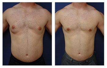 Before and after tummy tuck for gynecomastia patients.