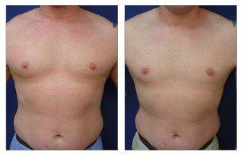 Tummy tuck before and after with gynecomastia.