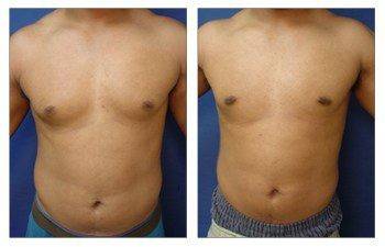 Before and after pictures of tummy tuck and gynecomastia.