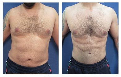 Gynecomastia Los Angeles