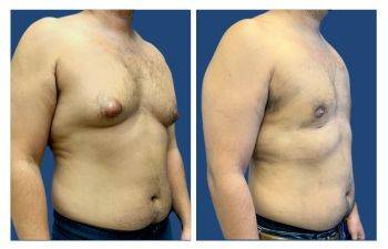 Tummy tuck and gynecomastia before and after.