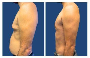 Tummy tuck before and after with gynecomastia.