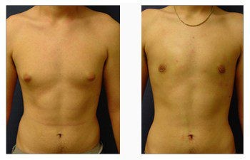 Tummy tuck with before and after photos, focusing on gynecomastia.