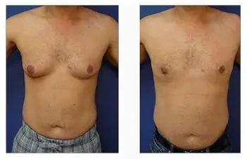 Tummy tuck and gynecomastia before and after.