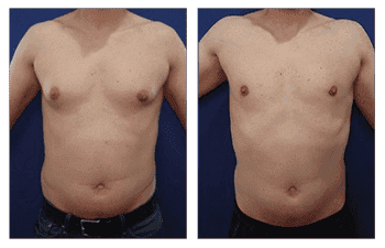 Tummy tuck and gynecomastia before and after.