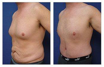 Tummy tuck with before and after gynecomastia transformation.