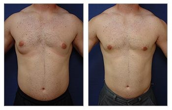 Before and after gynecomastia tummy tuck.