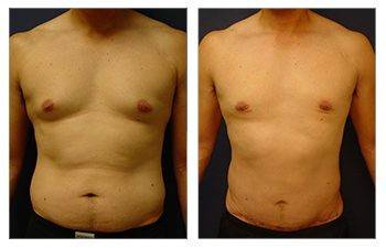 Tummy tuck and gynecomastia "before and after" transformation.