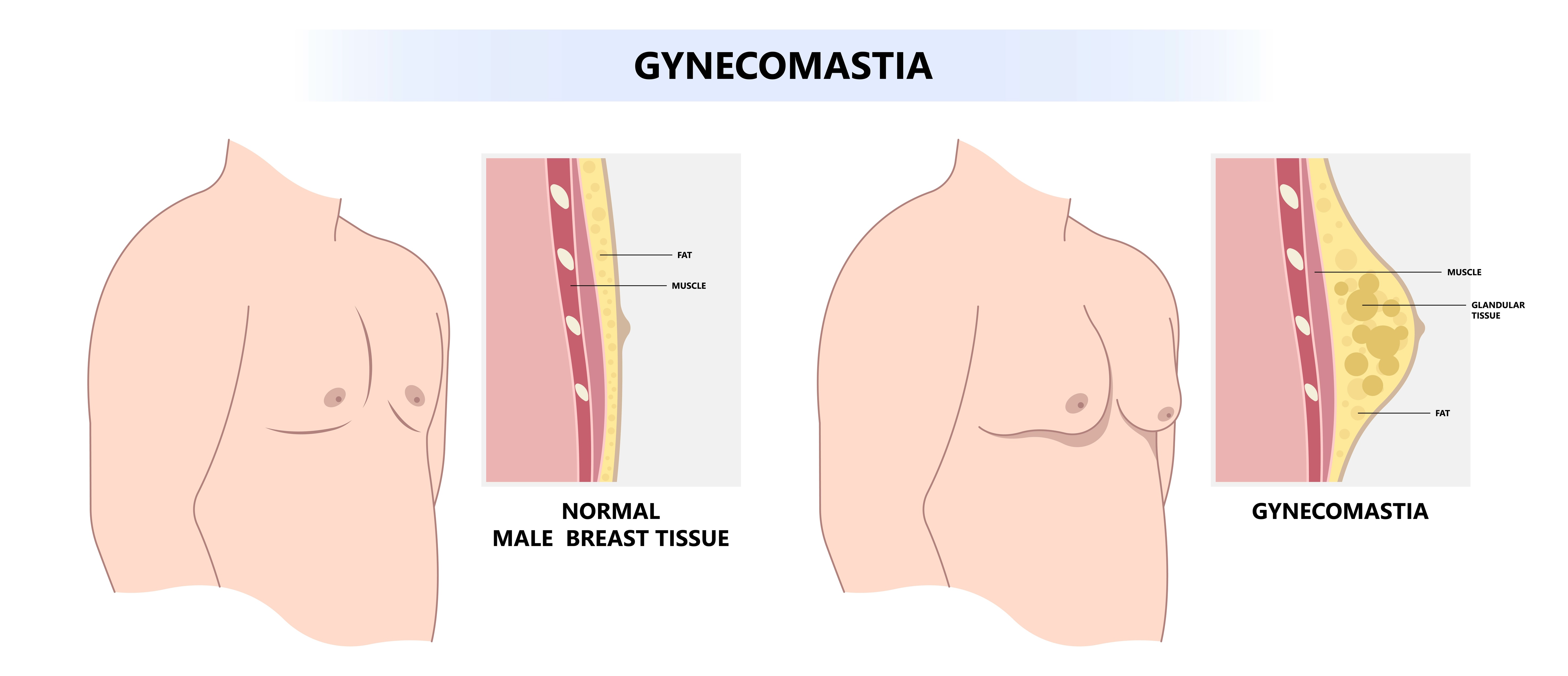 Male nipple surgery for gynecomastia.