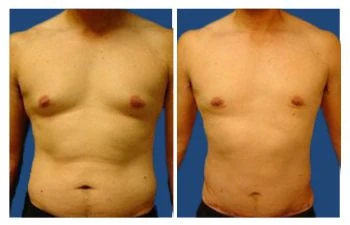 Gyno before and after.