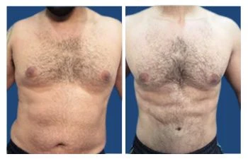 Gyno before and after results - Gynecomastia Center of Los Angeles