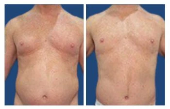 Gyno before and after results - Gynecomastia Center of Los Angeles